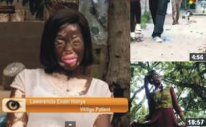A Ghanaian Journalist's Documentary on Vitiligo covering Heikeens Enam